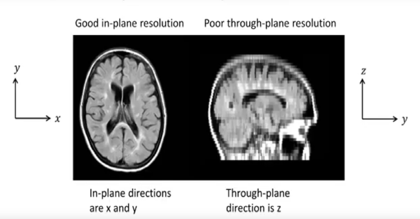 Prof. Jerry L. Prince gives a keynote talk, titled "No-atlas super-resolution for anisotropic voxels in medical imaging", which he delivered to the CVPR Workshop MCV 2020.