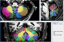 Vermis with all lobes1.jpg