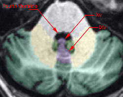 Vermis Axial2.jpg