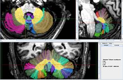 Vermis with all lobes3.jpeg