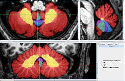 Vermis with all lobes1 red.jpg
