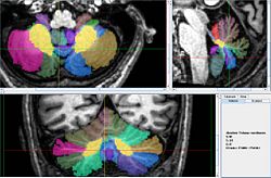 Vermis with all lobes2.jpg